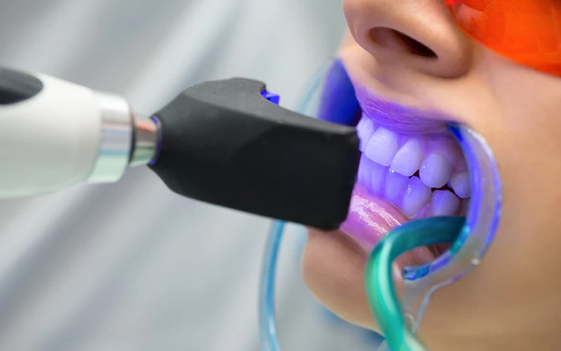 Teeth Whitening